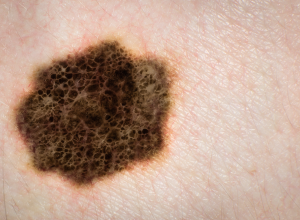 what is acral lentiginous melanoma #10