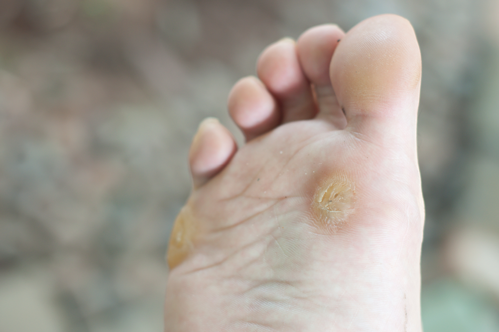 5 Quick Ways to Remove Hard Foot Skin, Corns and Calluses | Footfiles