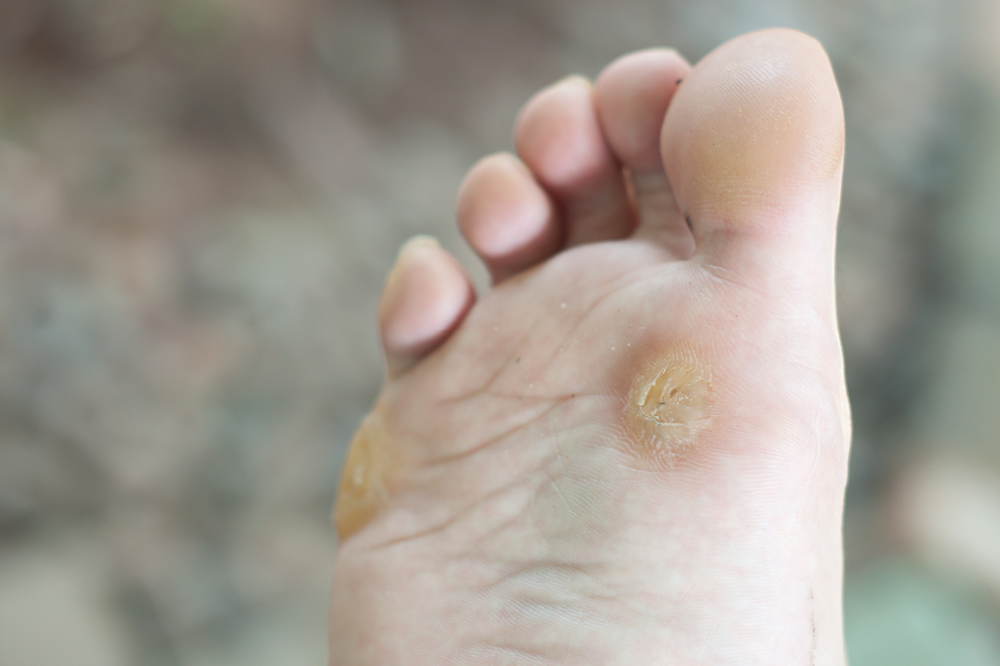 removing hard skin from sole of foot