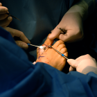 8 Mistakes Patients Make When Considering Bunion Surgery