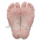 Skin peeling from the use of Baby Foot Peel