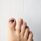 Black Toenail Causes Treatment Grow Out Facts