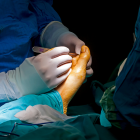 Cheilectomy Surgery: What It Is, What To Expect