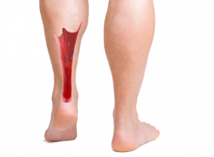 Achilles Tendon Achilles Tendon location