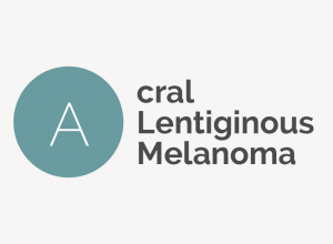 Acral Lentiginous Melanoma Definition 
