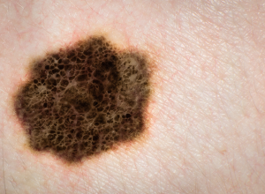 Acral Lentiginous Melanoma