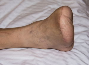 Amputation Amputation of the Toes