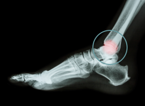 Ankle Arthritis Ankle Arthritis