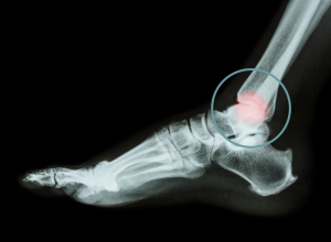 Ankle Arthritis 