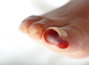 Blood Blister Blood Blister