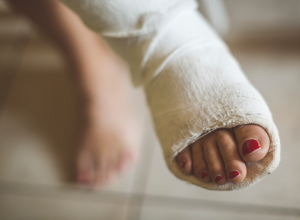 Bone Fracture Bone Fracture