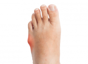 Bunionette (Tailor's Bunion): Symptoms 