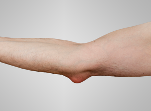 Bursitis Bursitis