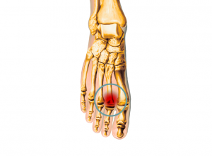 Capsulitis 