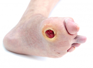 Charcot Foot