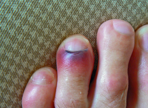 Chilblains Chilblains