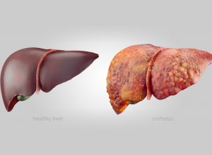 Cirrhosis 