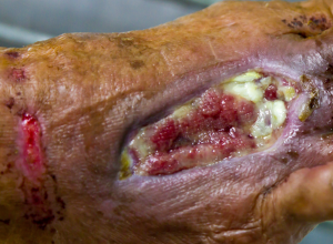Debridement Debridement