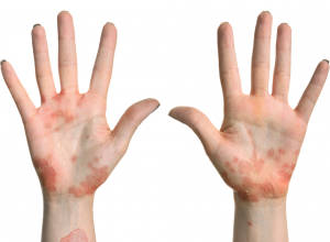 Eczema on the hands and wrists