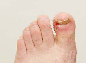 foot with a bloody ingrown toenail