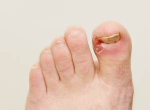 Ingrown Toenail foot with a bloody ingrown toenail