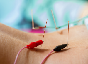 Electroacupuncture 