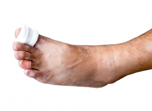 Foot and Toe Fractures Man With Broken, Casted Big Toe