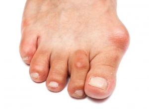 Hallux Abducto Valgus Bunion Hallux Abducto Valgus Bunion