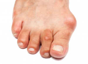 Hallux Abducto Valgus Bunion 