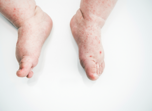 Baby With Sores Caused By Hand, Foot And Mouth Disease