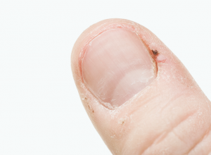 Hangnail 