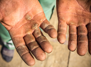 Hyperkeratosis shown on a man&#039;s palms