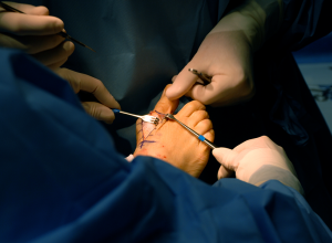 8 Mistakes Patients Make When Considering Bunion Surgery