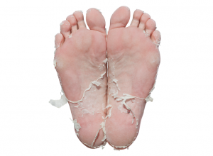 Skin peeling from the use of Baby Foot Peel