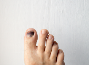 Black Toenail Causes Treatment Grow Out Facts