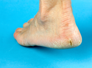 How to Cure a Heel Fissure Severely Cracked Heel