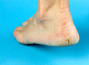 Heel Fissures: Symptoms, Causes 