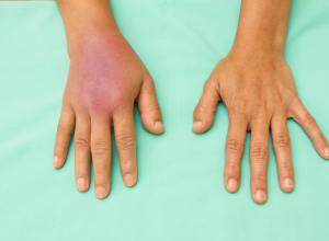 Inflammation Acute and Chronic Inflammation Acute and Chronic