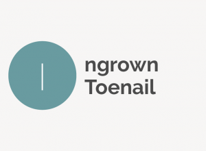 Ingrown Toenail Definition 