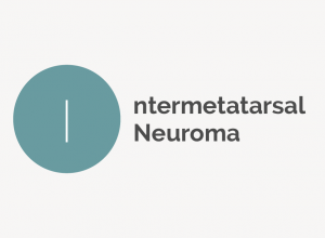 Intermetatarsal Neuroma Definition 