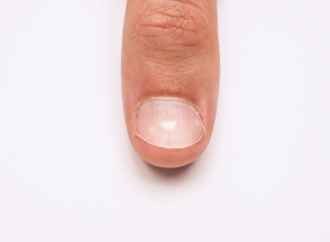 Keratin Granulation Keratin Granulation on a Fingernail