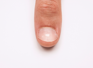 Keratin Granulation on a Fingernail