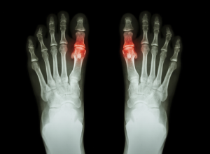 Metatarsophalangeal Articulations Metatarsophalangeal Articulations