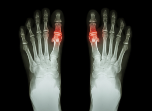 Metatarsophalangeal Articulations