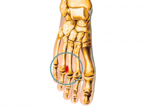 Morton&#039;s Neuroma