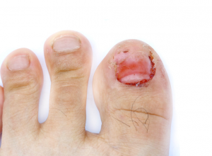 Onychectomy A Foot With The Big Toenail Removed