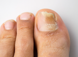 Onycholysis Onycholysis
