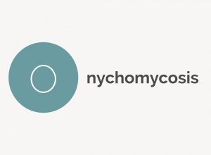 Onychomycosis Definition 