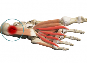Plantar Fascia Plantar Fascia