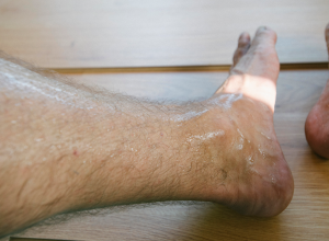Plantar Hyperhidrosis Plantar Hyperhidrosis